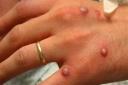 A case of monkeypox has been identified in Hertfordshire, the county council has said (File picture)